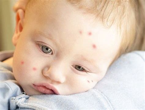 11 Natural Ways To Protect Your Child From Mosquito Bites Sick Baby