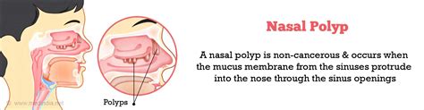 Nasal Polyp Frequently Asked Questions