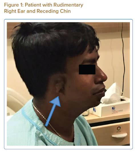 Patient With Rudimentary Right Ear And Receding Chin Recessed Chin