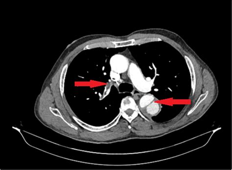 Ct Scan Aortic Dissection Longitudinal View Doccheck