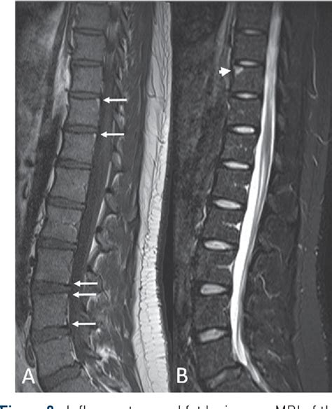 Figure 2 From Imaging In Ankylosing Spondylitis Semantic Scholar