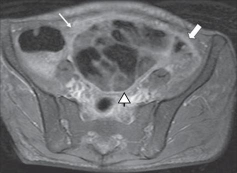 Pleural effusions are seen in the vast majority of patients at some stage during their disease 20. Cystic Peritoneal Mesothelioma Radiology