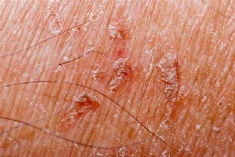 Hard Scaly Skin Disease Medical Information