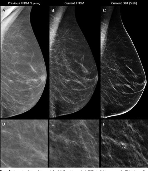 Figure 3 From Digital Mammography Versus Digital Mammography Plus