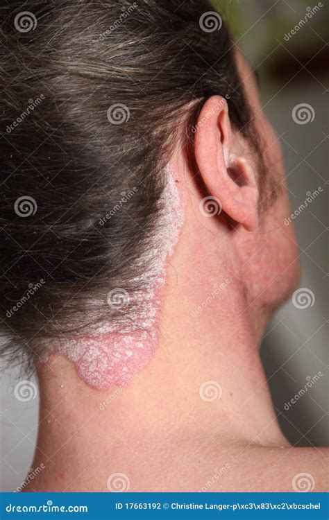 Severe Psoriasis Neck And Neck Stock Photography Image 17663192