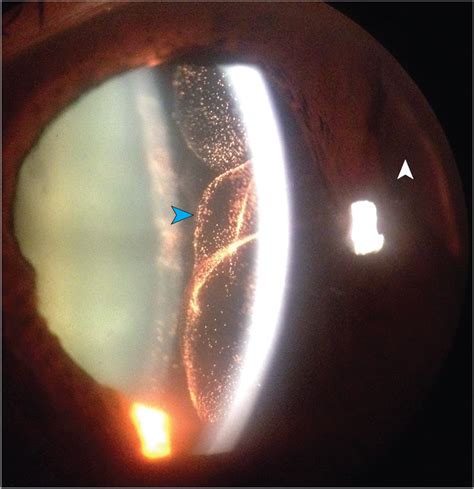 Vitreous Herniation After A Blow To The Eye Cataract And Other Lens