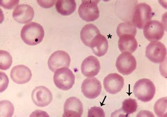 zoel blog: Anemia Hemolotik