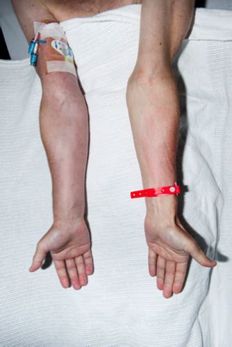 Upper Extremity Deep Vein Thrombosis A Complication Of An Indwelling
