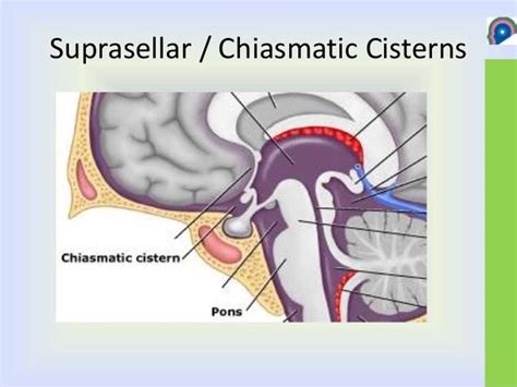 Basal Cisterns Anatomy