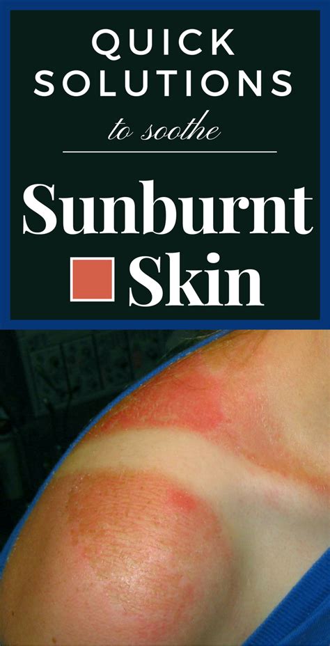 Quick Solutions To Soothe Sunburnt Skin Good Health Tips Sunburnt