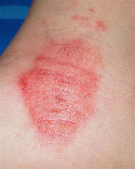 Identifying Common Red Spots On Skin Universal Dermatology