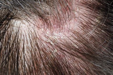 Psoriasis On The Scalp Stock Image C0167374 Science Photo Library