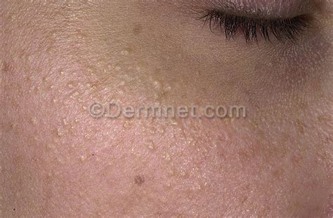 Milia Photo Skin Disease Pictures