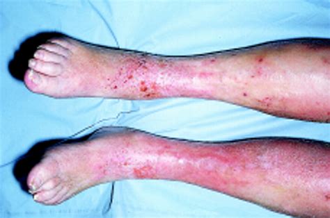 Importance Of Distinguishing Between Cellulitis And Varicose Eczema Of