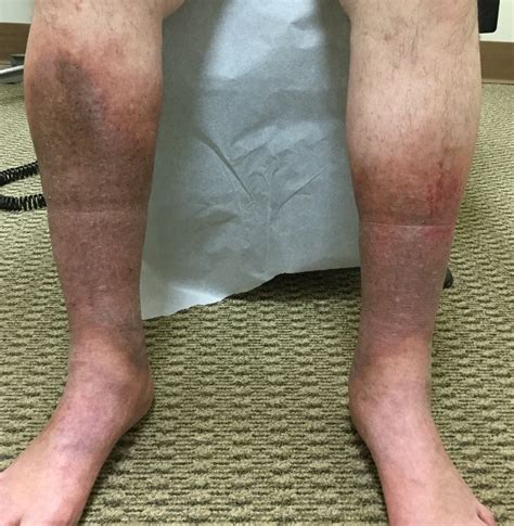 Flotte Baie Oxyde Black Spots On Legs Camarade Ordinaire Confus
