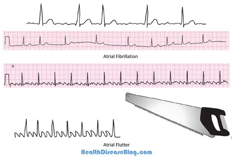 Atrial Fibrillation Classification Diagnosis Causes Clinical