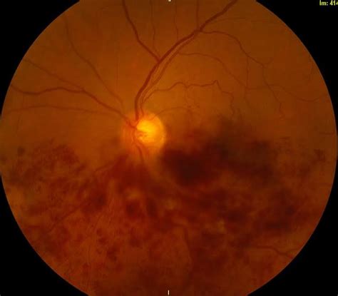Ischemic Central Retinal Vein Occlusion