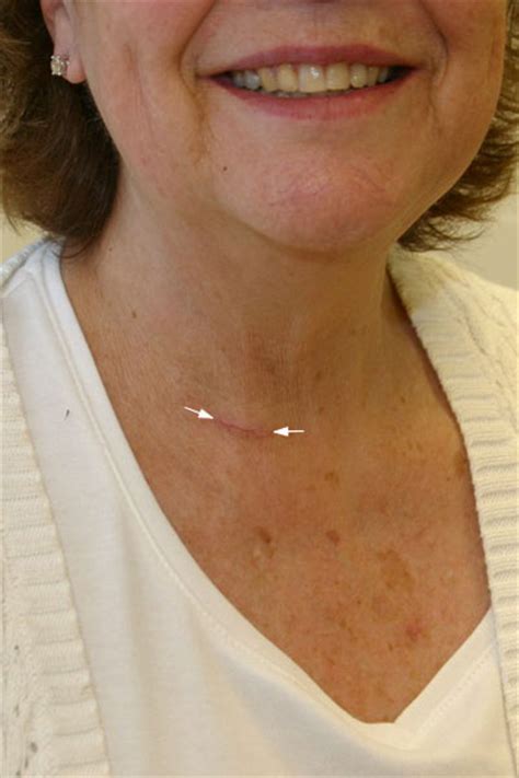 Thyroid Nodules Removal
