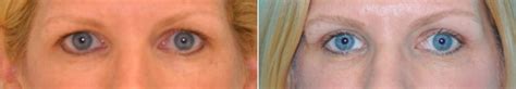 Blepharoplasty Photos Chevy Chase Md Patient 14609