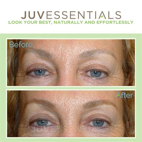 Laser tattoo removal is the safest and most effective means of eliminating an unwanted tattoo. Can eyeliner tattoo be removed or corrected? You bet! Go to http://juvessentials.com to learn ...