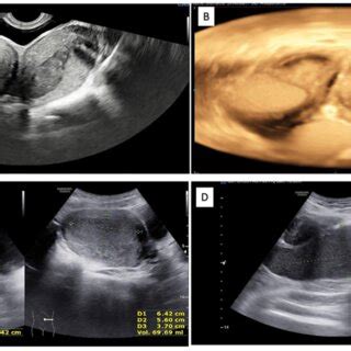 Ultrasound Images Of A Images Of Bicorporeal Uterus With Hematometra