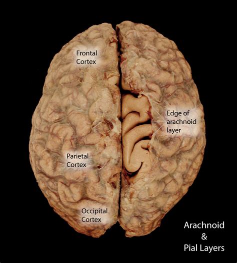 Arachnoid Mater Brain