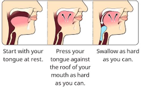 Management Of Dysphagia Healthtips By TeleMe