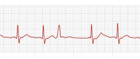 Using My Apple Watch Ecg I Managed To Finally Catch This Recurring