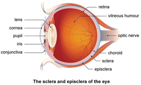 Episcleritis Nodular Episcleritis Causes Signs Symptoms And Treatment