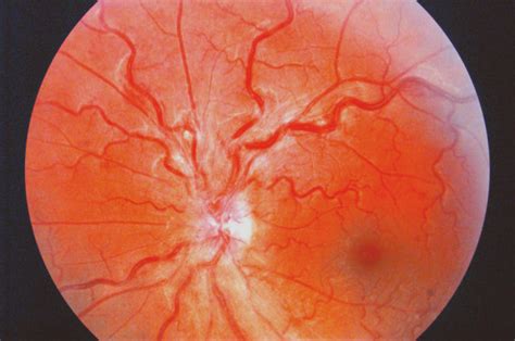 Funduscopic Image Of The Left Eye Fundus Photograph Of The Patients