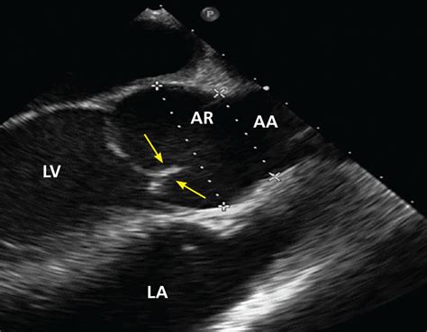Bicuspid Aortic Valve Basics And Beyond Cleveland Clinic Journal Of Medicine