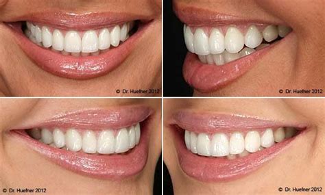 Perfect Teeth Shape Invisalign Smile Pinterest Perfect Teeth