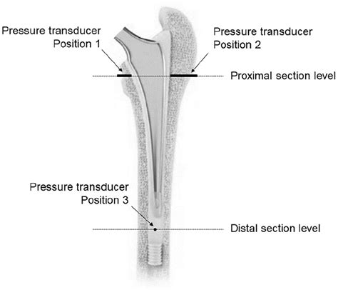 Does The Line To Line Cementing Technique Of The Femoral Stem Create An