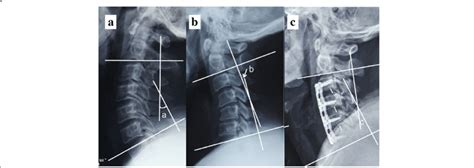 The Cervical Lordosis Cl Namely As C2 7 Cobb Angle Was Calculated