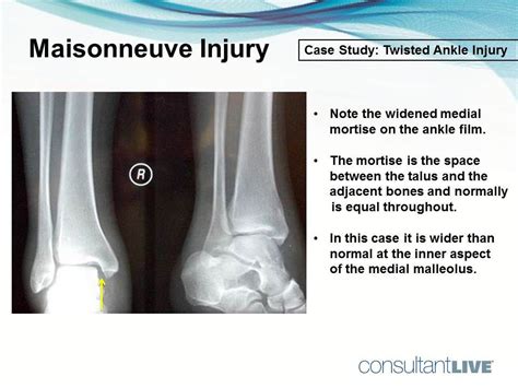 Ankle Injury Can You Find The Twist Patient Care Online