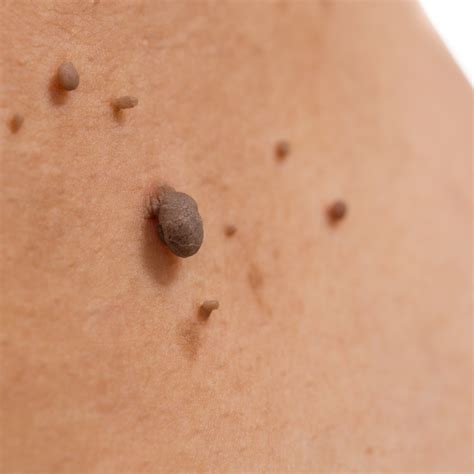Mole Removal Reasons And Treatments
