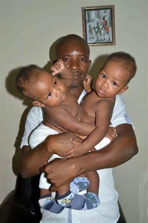 Nigerian Conjoined Twins Finally Gets Separated After Successful