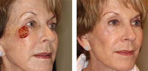 Before And After Skin Cancer Reconstruction Surgery Photos Dr Michael