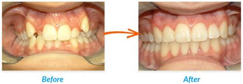 Kami menawarkan rawatan pergigian seperti pembedahan pergigian, veneers, rawatan laser, air flow scaling, crown dan bridges, implants, braces, pemutihan gigi dan banyak lagi. Pasang Behel/Kawat Gigi Murah Juni 2020 | Puri Dental Clinic
