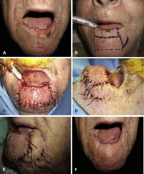 Subcutaneous pedicle chin flap combined with lateral ...