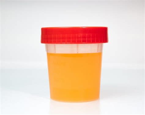 Common Causes Of Dark Urine Treatment And Prevention Tips