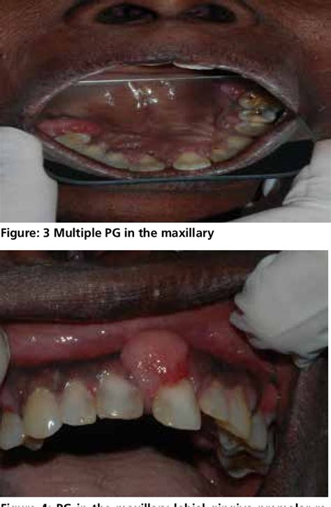 Figure From Intra Oral Multiple Pyogenic Granuloma A Rare Case