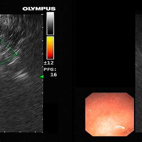 Endoscopic Ultrasound Guided Fine Needle Aspiration Procedure