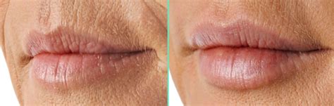Smokers Lines Get Rid Of Lip Lines Smokers Lip Treatment Lip