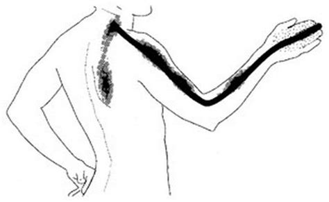 Cervical Radiculopathy Spine Orthobullets