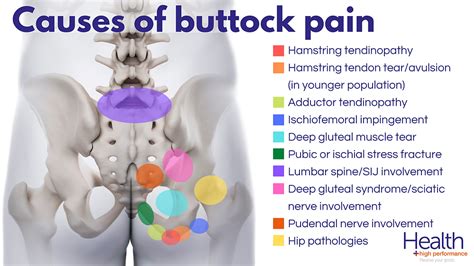 Pain In The Butt What Could It Be