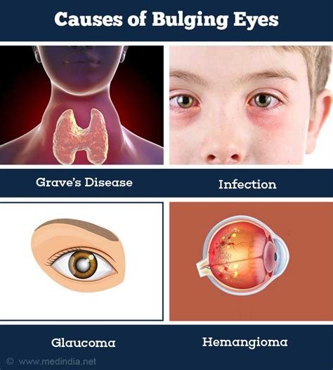 Exophthalmos Bulging Eyes Due To Thyroid Disease Stock