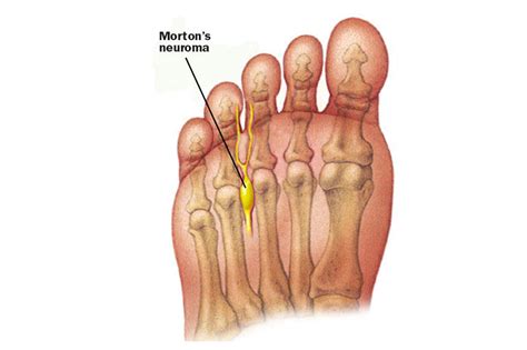 Mortons Neuroma London Uk Foot Surgery London