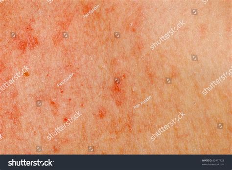 Allergic Rash Dermatitis Skin Texture Patient Stock Photo Edit Now
