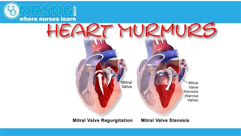 Heart Murmurs Aorticmitral Stenosis Regurgitation How To Identify